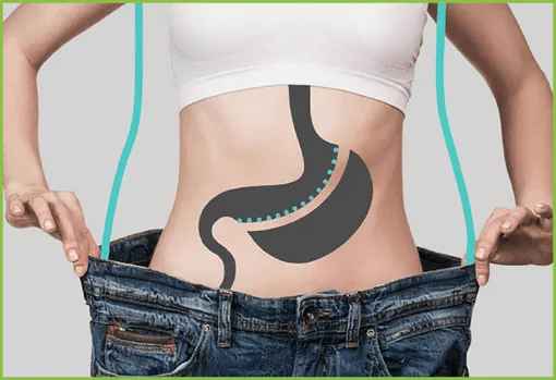 sleeve gastrique Tunisie