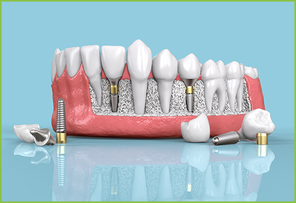 implant dentaire tunisie