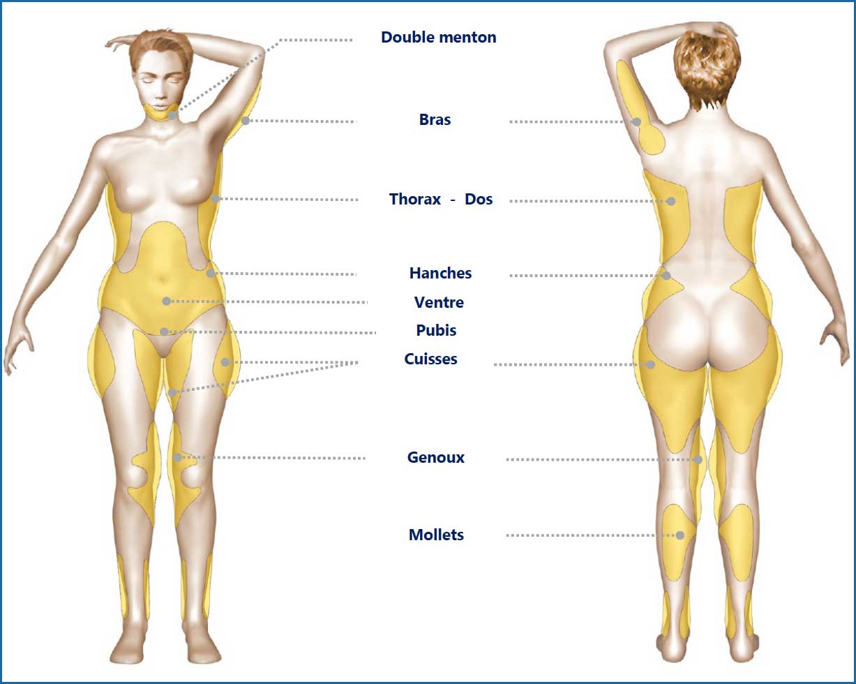 liposuccion tunisie ventre